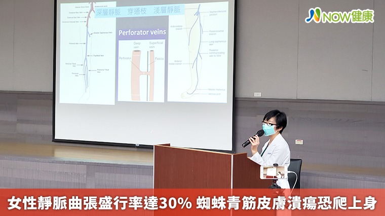 女性靜脈曲張盛行率達30% 蜘蛛青筋皮膚潰瘍恐爬上身 女性靜脈曲張盛行率達30% 蜘蛛青筋皮膚潰瘍恐爬上身