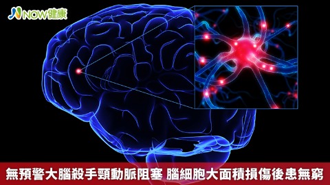 無預警大腦殺手頸動脈阻塞 腦細胞大面積損傷後患無窮