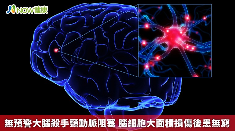 無預警大腦殺手頸動脈阻塞 腦細胞大面積損傷後患無窮 無預警大腦殺手頸動脈阻塞 腦細胞大面積損傷後患無窮