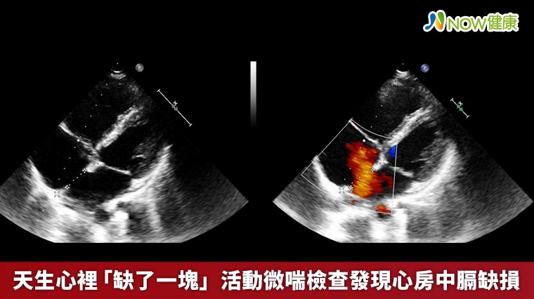 天生心裡「缺了一塊」 活動微喘檢查發現心房中膈缺損