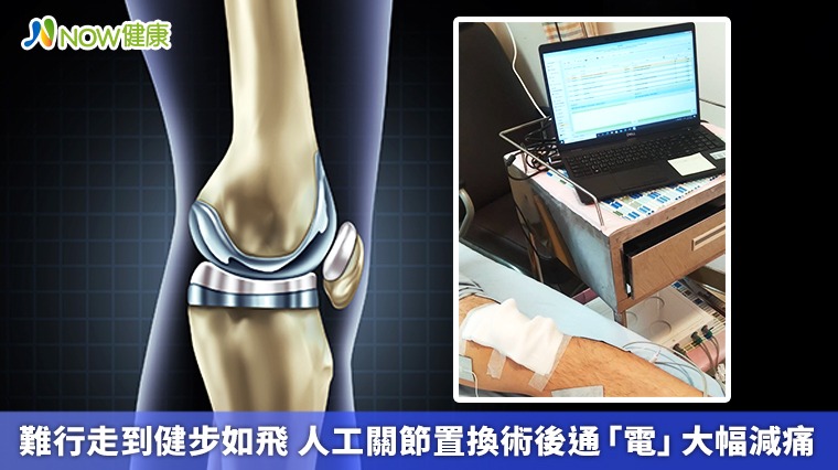 難行走到健步如飛 人工關節置換術後通「電」大幅減痛 難行走到健步如飛 人工關節置換術後通「電」大幅減痛