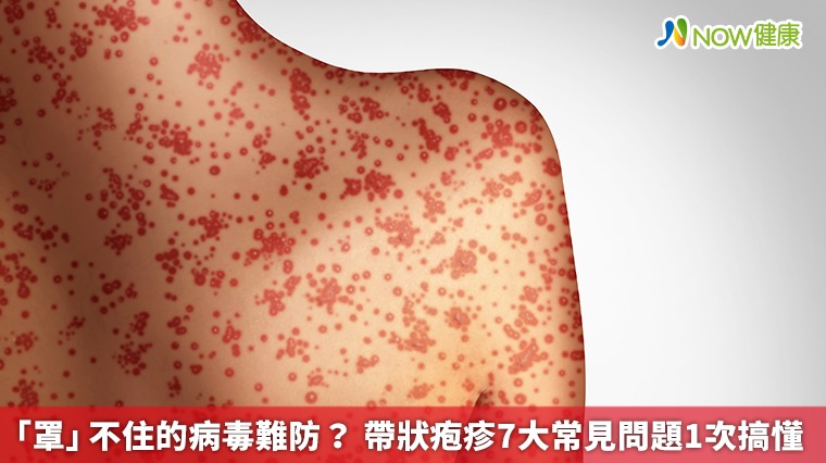 「罩」不住的病毒難防? 帶狀疱疹7大常見問題1次搞懂 「罩」不住的病毒難防? 帶狀疱疹7大常見問題1次搞懂