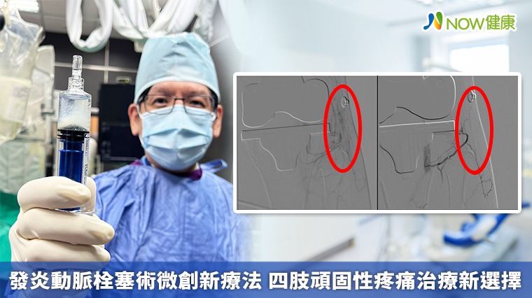 發炎動脈栓塞術微創新療法 四肢頑固性疼痛治療新選擇 發炎動脈栓塞術微創新療法 四肢頑固性疼痛治療新選擇