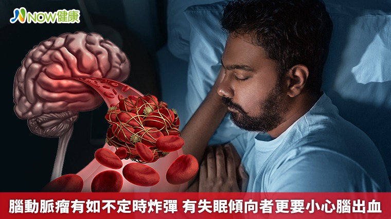 腦動脈瘤有如不定時炸彈 有失眠傾向者更要小心腦出血