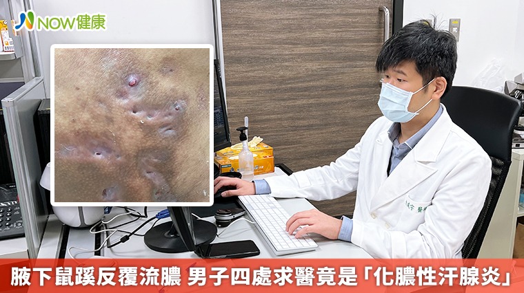 腋下鼠蹊反覆流膿 男子四處求醫竟是「化膿性汗腺炎」 腋下鼠蹊反覆流膿 男子四處求醫竟是「化膿性汗腺炎」