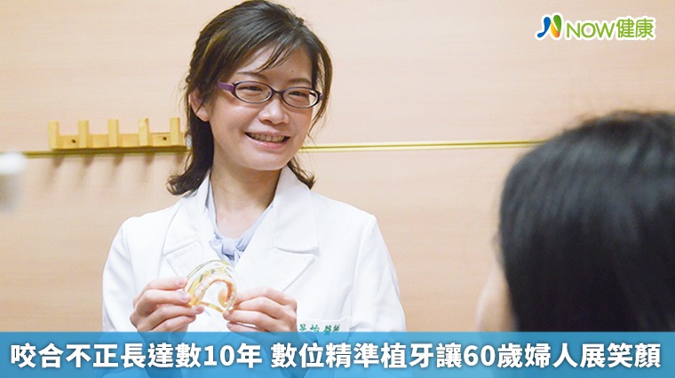 咬合不正長達數10年 數位精準植牙讓60歲婦人展笑顏