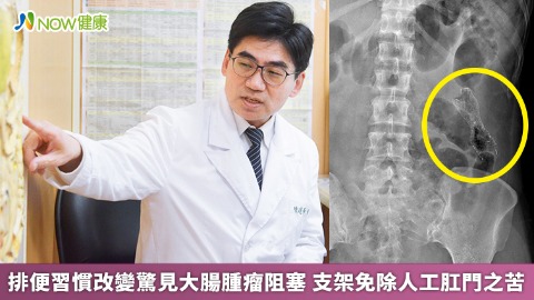 排便習慣改變驚見大腸腫瘤阻塞 支架免除人工肛門之苦