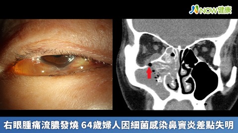  右眼腫痛流膿發燒 64歲婦人因細菌感染鼻竇炎差點失明