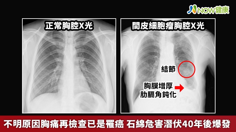 不明原因胸痛再檢查已是罹癌 石綿危害潛伏40年後爆發