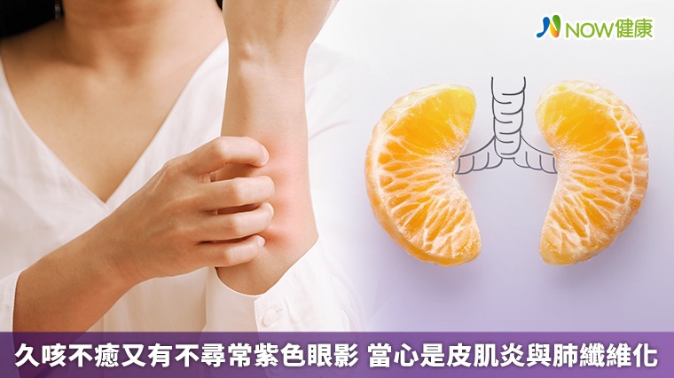 久咳不癒又有不尋常紫色眼影 當心是皮肌炎與肺纖維化 久咳不癒又有不尋常紫色眼影 當心是皮肌炎與肺纖維化