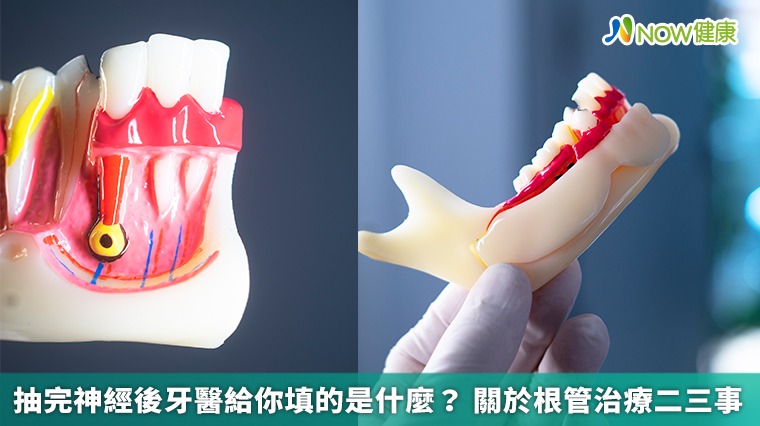 抽完神經後牙醫給你填的是什麼？ 關於根管治療二三事