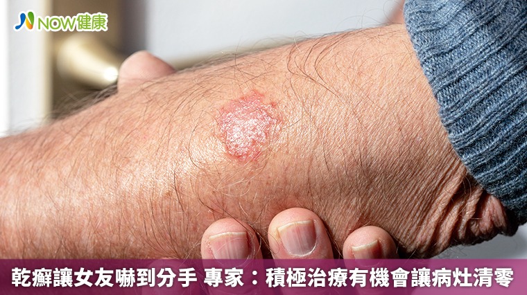 乾癬讓女友嚇到分手 專家:積極治療有機會讓病灶清零 乾癬讓女友嚇到分手 專家:積極治療有機會讓病灶清零