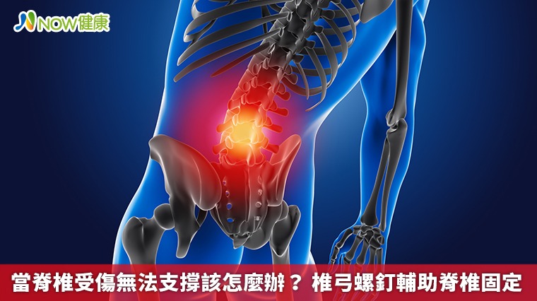 當脊椎受傷無法支撐該怎麼辦? 椎弓螺釘輔助脊椎固定 當脊椎受傷無法支撐該怎麼辦? 椎弓螺釘輔助脊椎固定