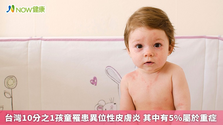 台灣10分之1孩童罹患異位性皮膚炎 其中有5%屬於重症 台灣10分之1孩童罹患異位性皮膚炎 其中有5%屬於重症