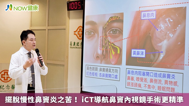 擺脫慢性鼻竇炎之苦! iCT導航鼻竇內視鏡手術更精準 擺脫慢性鼻竇炎之苦! iCT導航鼻竇內視鏡手術更精準
