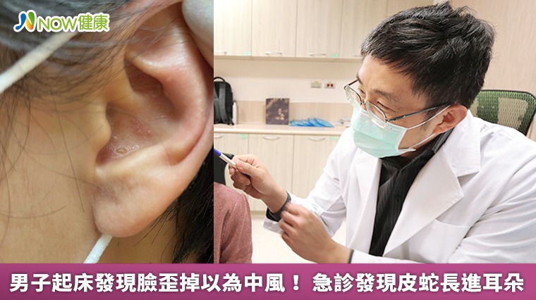 男子起床發現臉歪掉以為中風! 急診發現皮蛇長進耳朵 男子起床發現臉歪掉以為中風! 急診發現皮蛇長進耳朵
