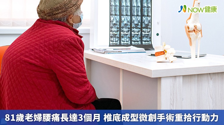 81歲老婦腰痛長達3個月 椎底成型微創手術重拾行動力 81歲老婦腰痛長達3個月 椎底成型微創手術重拾行動力