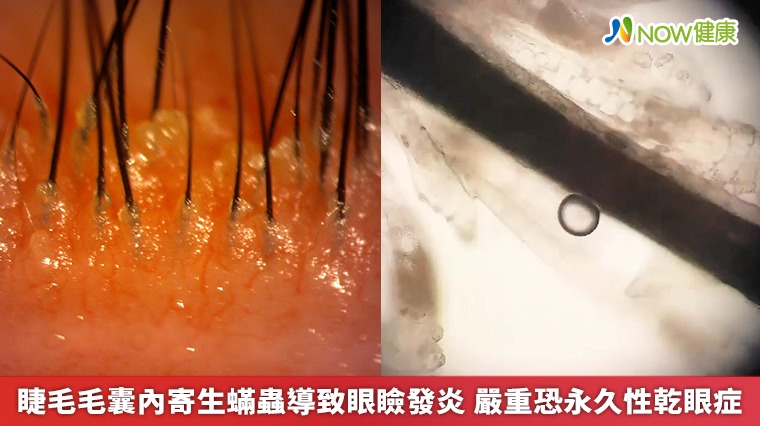 睫毛毛囊內寄生蟎蟲導致眼瞼發炎 嚴重恐永久性乾眼症 睫毛毛囊內寄生蟎蟲導致眼瞼發炎 嚴重恐永久性乾眼症