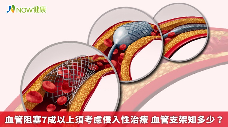 血管阻塞7成以上須考慮侵入性治療 血管支架知多少? 血管阻塞7成以上須考慮侵入性治療 血管支架知多少?