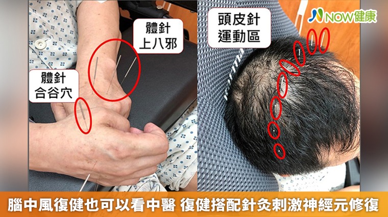 腦中風復健也可以看中醫 復健搭配針灸刺激神經元修復