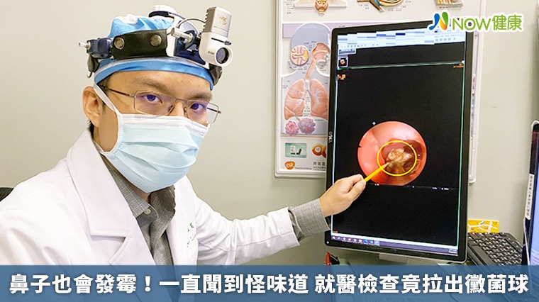 鼻子也會發霉!一直聞到怪味道 就醫檢查竟拉出黴菌球 鼻子也會發霉!一直聞到怪味道 就醫檢查竟拉出黴菌球