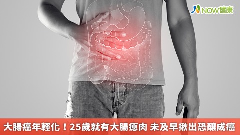 大腸癌年輕化！25歲就有大腸瘜肉 未及早揪出恐釀成癌