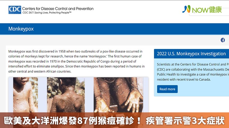 歐美及大洋洲爆發87例猴痘確診! 疾管署示警3大症狀 歐美及大洋洲爆發87例猴痘確診! 疾管署示警3大症狀