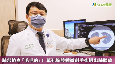 肺部檢查「毛毛的」！ 單孔胸腔鏡微創手術揪出肺腺癌