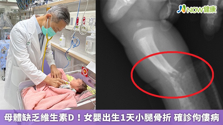 母體缺乏維生素D！女嬰出生1天小腿骨折 確診佝僂病