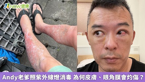 Andy老爹照紫外線燈消毒 為何皮膚、眼角膜會灼傷？