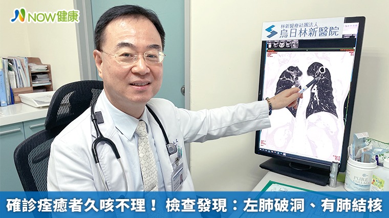 確診痊癒者久咳不理！ 檢查發現：左肺破洞、有肺結核