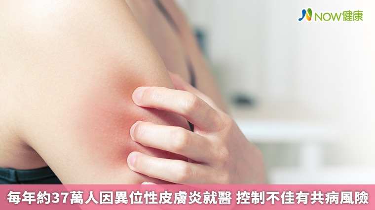 每年約37萬人因異位性皮膚炎就醫 控制不佳有共病風險 每年約37萬人因異位性皮膚炎就醫 控制不佳有共病風險