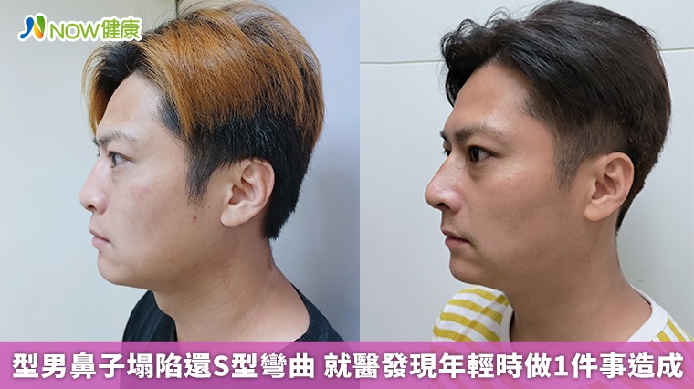 型男鼻子塌陷還S型彎曲 就醫發現年輕時做1件事造成