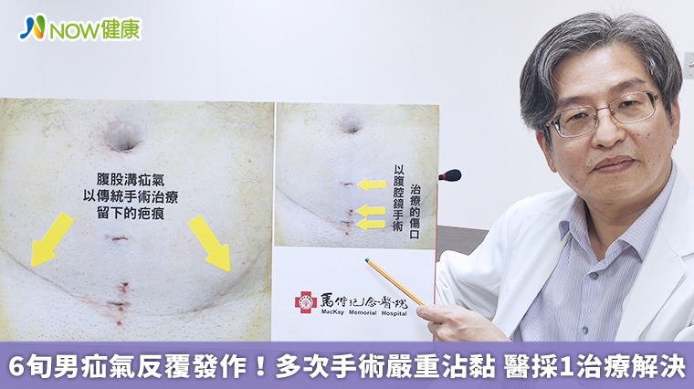 6旬男疝氣多次復發!醫以腹腔鏡手術解決沾黏問題 6旬男疝氣多次復發!醫以腹腔鏡手術解決沾黏問題