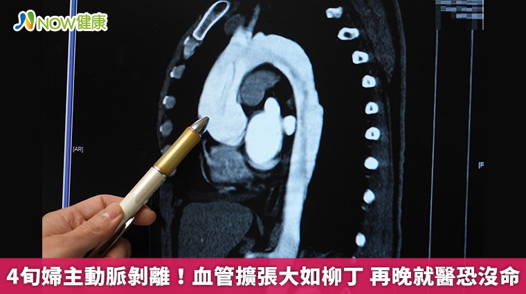 4旬婦主動脈剝離!血管擴張大如柳丁 再晚就醫恐沒命 4旬婦主動脈剝離!血管擴張大如柳丁 再晚就醫恐沒命
