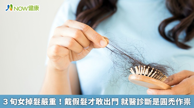 3旬女掉髮嚴重！戴假髮才敢出門 就醫診斷是圓禿作祟