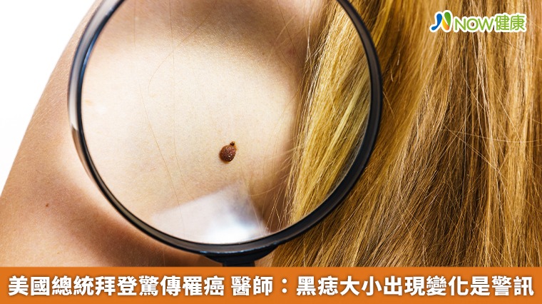 美國總統拜登驚傳罹癌 醫師:黑痣大小出現變化是警訊 美國總統拜登驚傳罹癌 醫師:黑痣大小出現變化是警訊