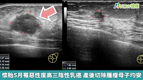 懷胎5月罹惡性度高三陰性乳癌 產後切除腫瘤母子均安