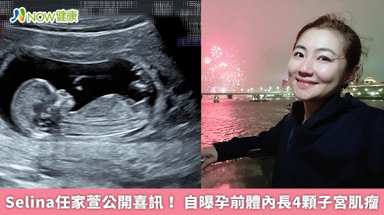 Selina任家萱公開喜訊! 自曝孕前體內長4顆子宮肌瘤 Selina任家萱公開喜訊! 自曝孕前體內長4顆子宮肌瘤