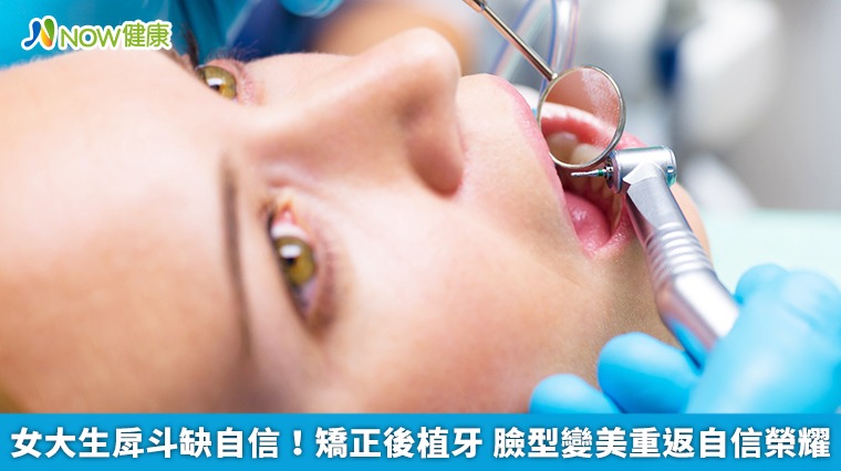 女大生戽斗缺自信!矯正後植牙 臉型變美重返自信榮耀 女大生戽斗缺自信!矯正後植牙 臉型變美重返自信榮耀