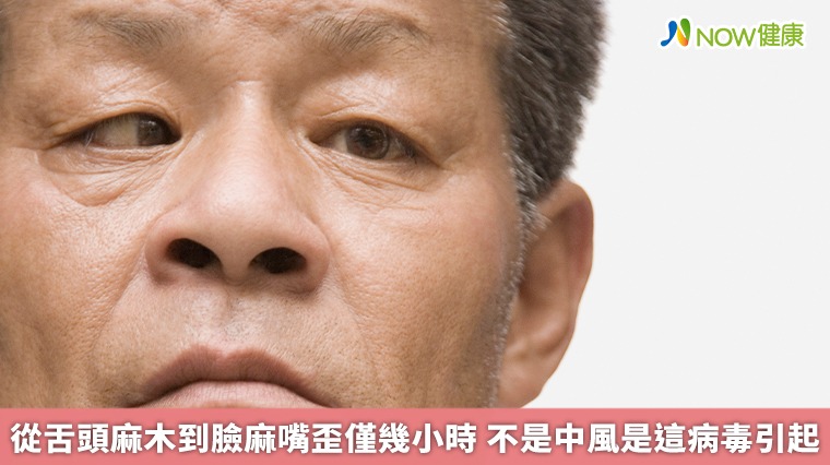 從舌頭麻木到臉麻嘴歪僅幾小時 不是中風是這病毒引起 從舌頭麻木到臉麻嘴歪僅幾小時 不是中風是這病毒引起
