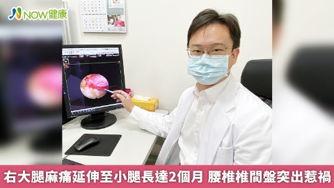 右大腿麻痛延伸至小腿長達2個月 腰椎椎間盤突出惹禍