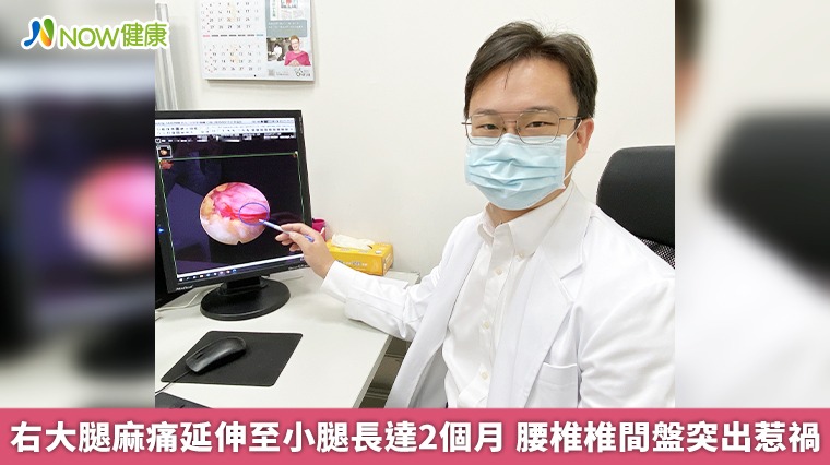 右大腿麻痛延伸至小腿長達2個月 腰椎椎間盤突出惹禍 右大腿麻痛延伸至小腿長達2個月 腰椎椎間盤突出惹禍