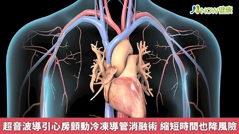 超音波導引心房顫動冷凍導管消融術 縮短時間也降風險