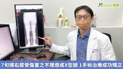 7旬婦右膝受傷置之不理造成X型腿 1手術治療成功矯正