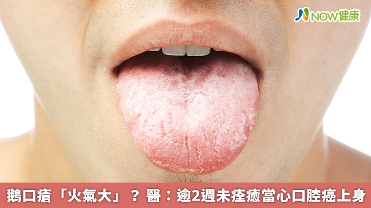 鵝口瘡「火氣大」？ 醫：逾2週未痊癒當心口腔癌上身