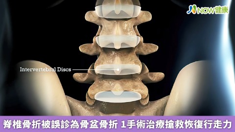 脊椎骨折被誤診為骨盆骨折 1手術治療搶救恢復行走力