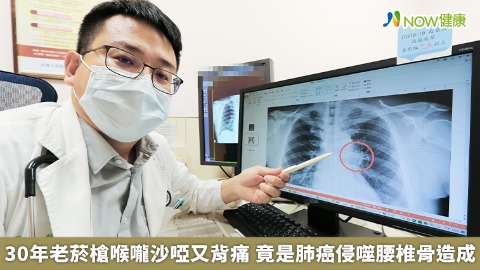 30年老菸槍喉嚨沙啞又背痛 竟是肺癌侵噬腰椎骨造成