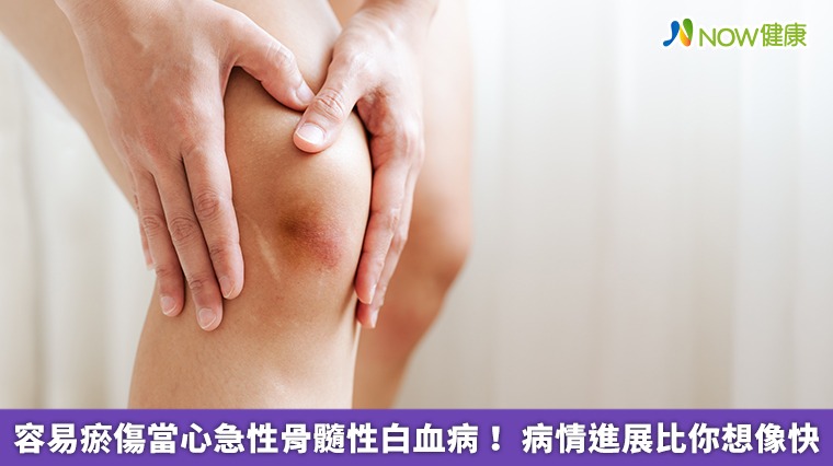 容易瘀傷當心急性骨髓性白血病! 病情進展比你想像快 容易瘀傷當心急性骨髓性白血病! 病情進展比你想像快