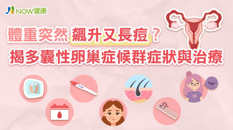 體重突然飆升又長痘? 揭多囊性卵巢症候群症狀與治療 體重突然飆升又長痘? 揭多囊性卵巢症候群症狀與治療